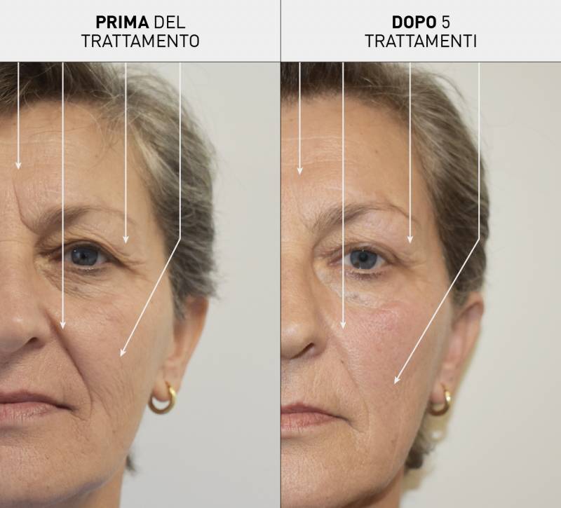 media/image/Trattamento-rughe-prima-e-dopo-NOVAFON-mezzo-viso.jpg